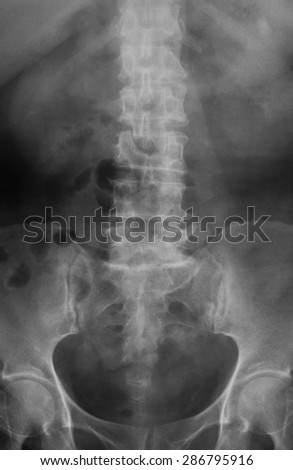 Xray Image Plan Kub Kidneyureter Bladder Stock Photo 302998895 ...