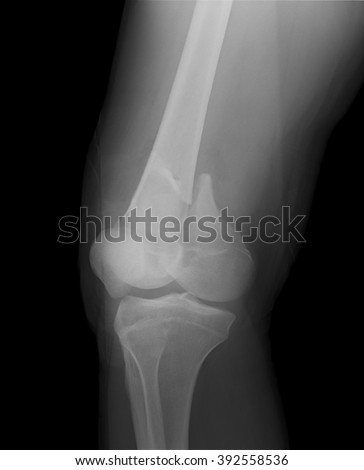 Broken Leg Xrays Image Showing Plate Stock Photo 129535328 - Shutterstock