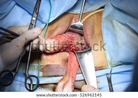 Entirely Uterus Outside Before Amputation During Stock Photo (Edit Now