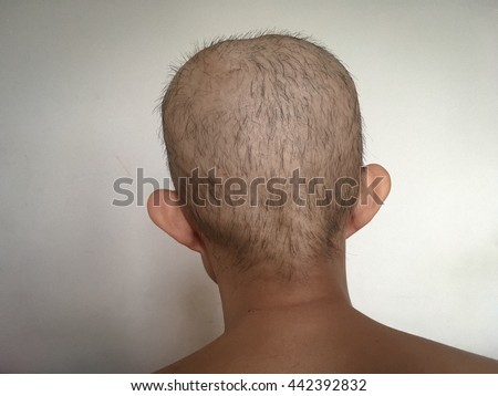 Perindopril Side Effects Hair Loss