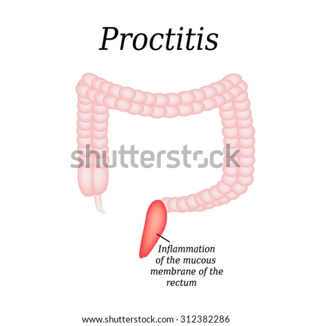 Pancolitis Stock Images, Royalty-Free Images & Vectors | Shutterstock