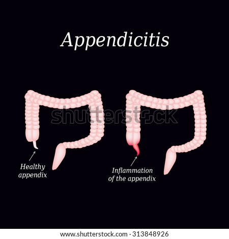 Appendicitis Stock Photos, Images, & Pictures | Shutterstock