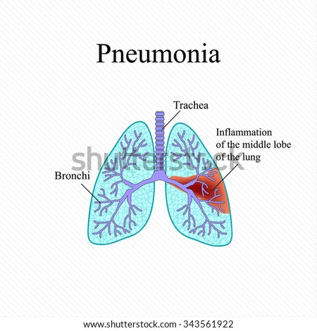 Tuberculosis Lung Disease Tubercle Bacillus Vector Stock Vector ...