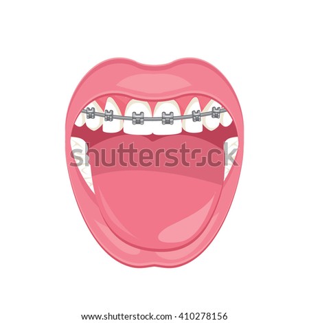 Braces Teeth Stock Photos, Images, & Pictures | Shutterstock