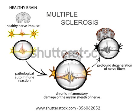 Multiple Sclerosis Stock Photos, Images, & Pictures | Shutterstock