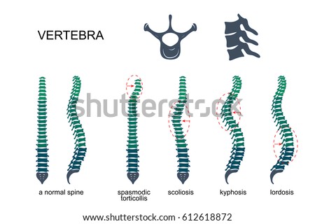 vector illustration of diseases of the spine.vertebrae