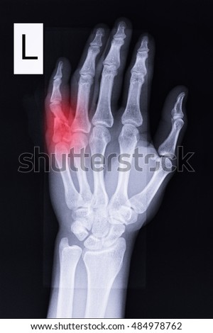 Dislocated Finger Two Projections Xray Ring Stock Photo 129995033 ...