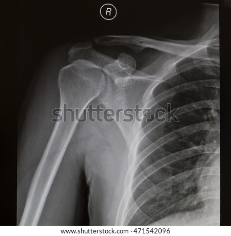 Right Shoulder Mri Woman Stock Photo 105327533 - Shutterstock