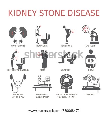 Diagram Of Where Kidney Stones Hurt Choice Image - How To 