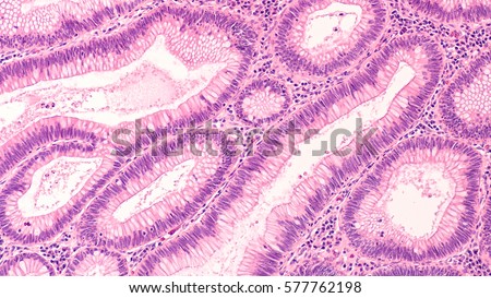 Microscopic Image Tubular Adenoma Adenomas Premalignant Stock Photo ...