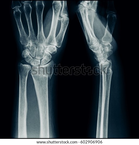 Xray Human Hand Wrist Stock Photo 62282380 - Shutterstock