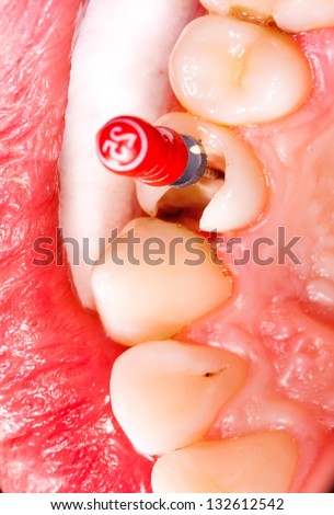 Tratamento e restauração de canal radicular dentário