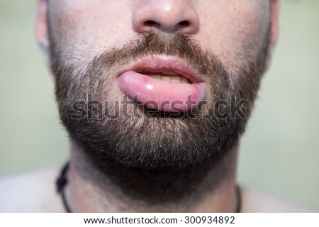 Facial lip swelling Facial lip swelling