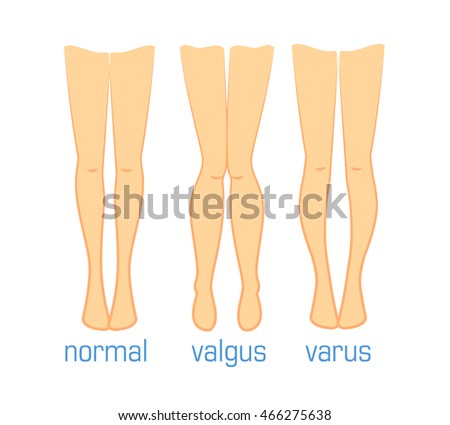 Vector Medical Illustration Human Leg Curvatures Stock Vector 466275638 ...