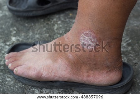 Il bruciato in gambe stupnyakh varicosity