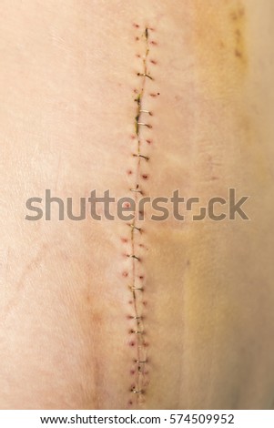 Surgical Staples Stock Images, Royalty-Free Images & Vectors | Shutterstock