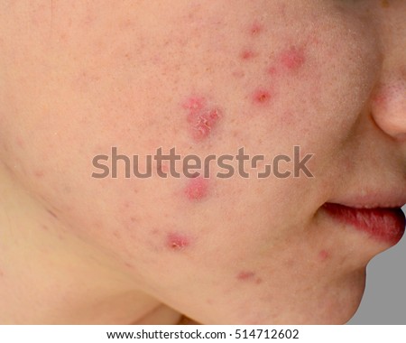 human skin with acne royalty free stock photos image 28330198 pustule stock images royalty free images vectors human skin with acne royalty free stock photos image 28330198 pustule stock images royalty free images vectors