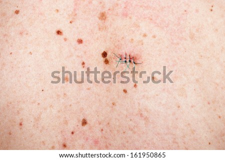 skin scar stock images royalty free images vectors human skin stitches moles blemishes scars stock photo royalty free 161950865 skin scar stock images royalty free images vectors human skin stitches moles blemishes scars stock photo royalty free 161950865