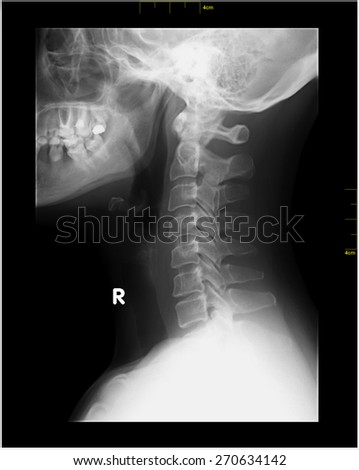 Lordosis Stock Images, Royalty-Free Images & Vectors | Shutterstock