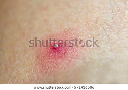 human skin with acne royalty free stock photos image 28330198 pustule stock images royalty free images vectors human skin with acne royalty free stock photos image 28330198 pustule stock images royalty free images vectors