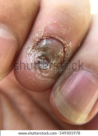 Close up of Fungus Infection on Nails Hand, Finger with onychomycosis.