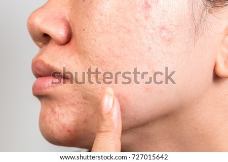 human skin with acne royalty free stock photos image 28330198 skin abscess stock images royalty free images vectors human skin with acne royalty free stock photos image 28330198 skin abscess stock images royalty free images vectors