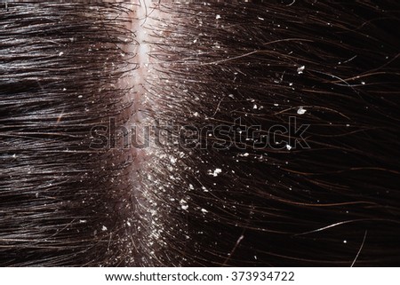 Dandruff Stock Images, Royalty-Free Images & Vectors 