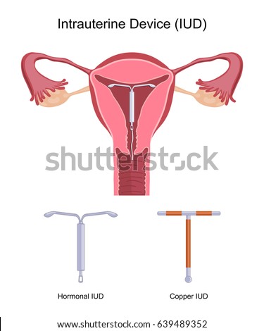 iud types