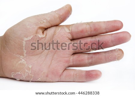 Dry Hands Peel Contact Dermatitis Fungal Stock Photo 446288338 ...