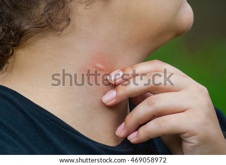 mosquito bites swollen skin bite reddened touched nature she shutterstock vectors royalty