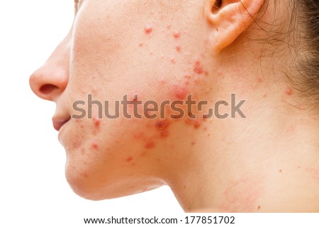 Acne skin because the disorders of sebaceous glands productions