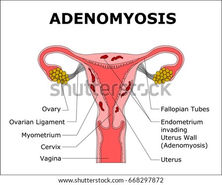 cartoon image of uterus