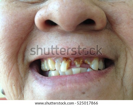 Woman Severe Dental Oral Tooth Decay Stock Photo 116033626 - Shutterstock