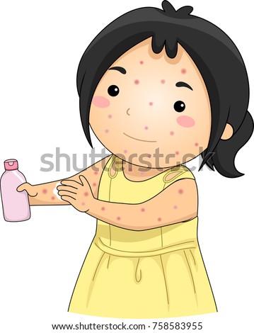 Illustration Kid Girl Chickenpox Applying Unscented Stock Vector ...