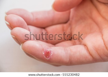 Open Wound Stock Images, Royalty-Free Images & Vectors | Shutterstock