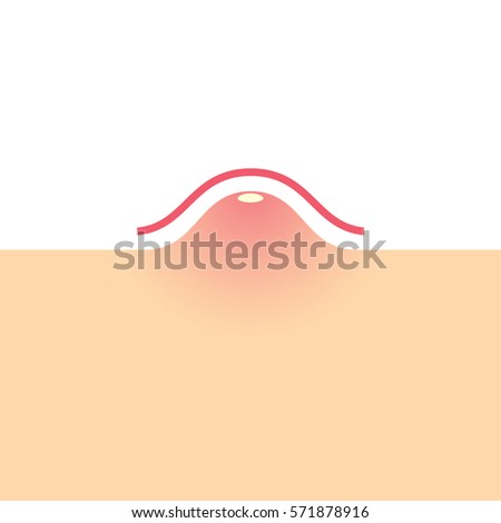Pustule Stock Images, Royalty-Free Images & Vectors | Shutterstock