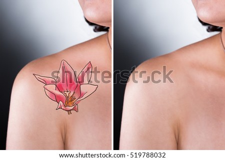 tattoo removal before after stock photo 566254282 shutterstock tattoo removal before after stock photo 566254282 shutterstock