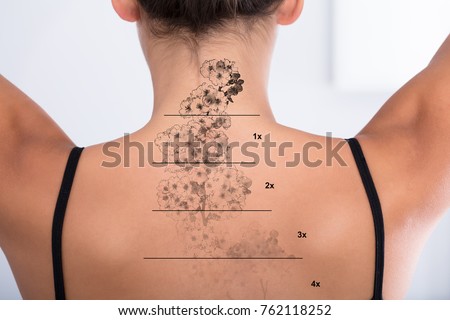 laser tattoo removal on mans hand stock photo 566473825 shutterstock laser tattoo removal on mans hand stock photo 566473825 shutterstock