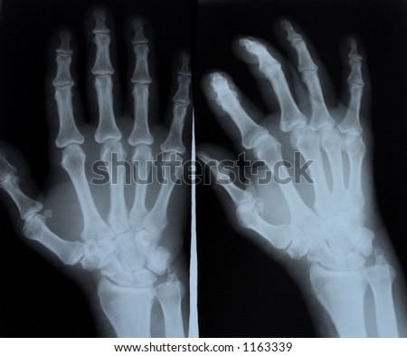 Human Right Left Foot Ankle Xray Stock Photo 72413068 - Shutterstock