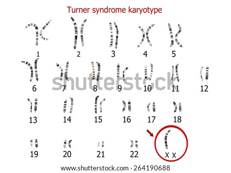 Turner Syndrome Karyotype Stock Illustration 264190688 - Shutterstock