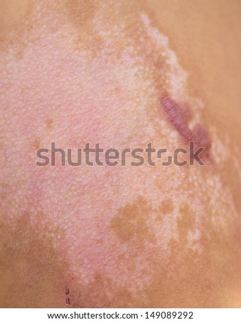 burn scar stock photo 57476164 wound on forehead stock photo 286496507 burn scar stock photo 57476164 wound on forehead stock photo 286496507