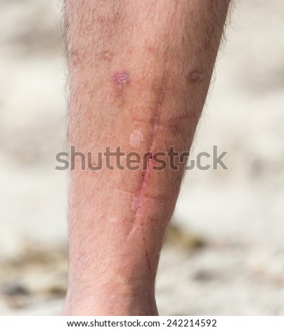 Scar-tissue Stock Photos, Images, & Pictures | Shutterstock