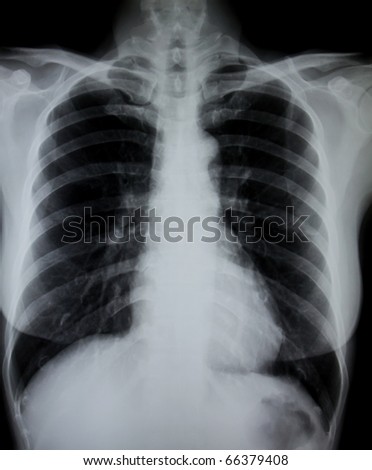 Smoker Lung Stock Photos, Images, & Pictures | Shutterstock