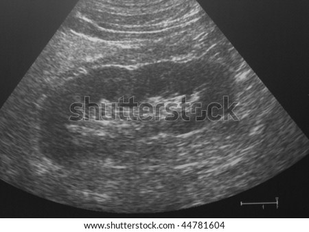 Ultrasound Image Human Normal Kidney Stock Photo (Royalty Free ...