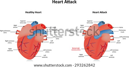 St Elevated Myocardial Infarction Stemi Stock Illustration 295625795 ...