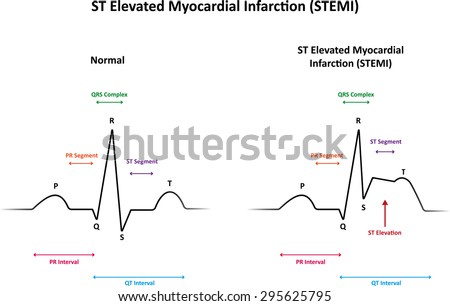 St Elevated Myocardial Infarction Stemi Stock Illustration 295625795 ...