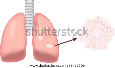 Granulomatous Lung Disease Labeled Diagram Stock Vector 399785500 ...