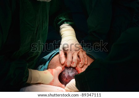New Baby Being Born During Cesarean Stock Photo 89347114 ...