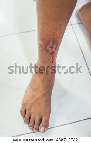 Gangrene Stock Photos, Royalty-Free Images & Vectors - Shutterstock