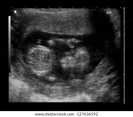 Ultrasound Fetus 12 Weeks Stock Photo 127636583 - Shutterstock